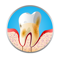 Cálculo dental Cálculo dental