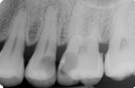 Radiografia periapical mostrando envolvimento pulpar por cárie dental Radiografia periapical mostrando envolvimento pulpar por cárie dental