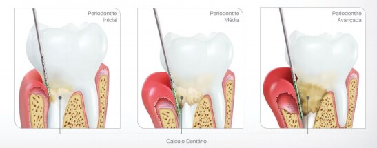 Folheto: Gengivite