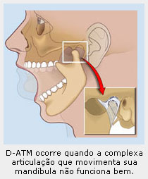 O que e uma disfunção da articulação temporomandibular (ATM)?