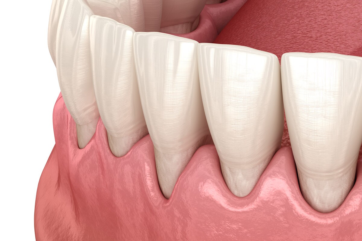 Diagrama dos tecidos periodontais após tratamento
