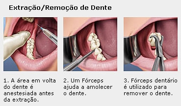 extração/Remoção de dente