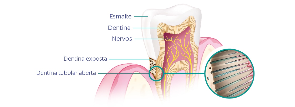 indicação de dentina